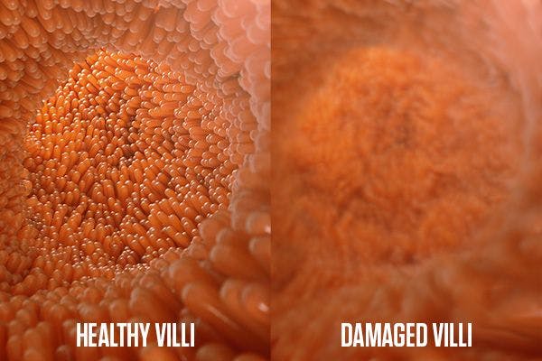 Villi Healthy vs Damaged